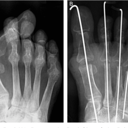 Rheumatoid arthritis with joint arthroplasty hesi case study