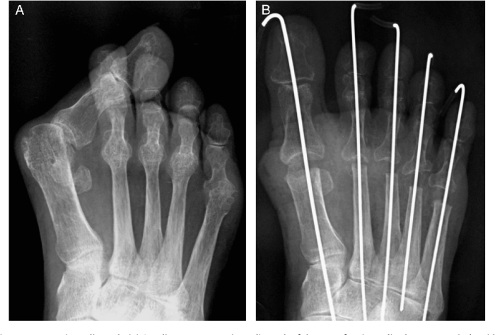 Rheumatoid arthritis with joint arthroplasty hesi case study